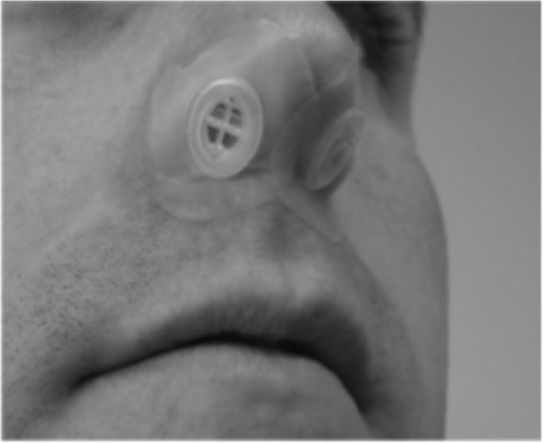 Figure 1 Photograph of the expiratory positive airway pressure device in place.
