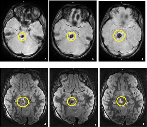 Figure 4 8-year-old girl, motor vehicle accident. 18 hours after the initial non enhanced CT scan, MRI is performed. (a-c) Grade III DAI involving the pons and mesencephalon (yellow circle) - SWI hypo signal (d-f) FLAIR hypo signal. (c-f) The haemorrhagic lesion is surrounded by oedema (FLAIR high signal).