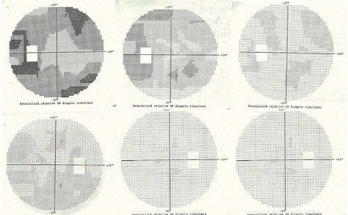 Figure 4. Visual fields before and after treatment for patient I. The upper row corresponds to the left eye, the lower row to the right eye. On each row, the first box is the visual field pre-treatment, the second box is the field after 6 months, and the third box is the field after 1 year. This patient maintained stable visual fields thereafter, with follow-up now approaching 8 years.