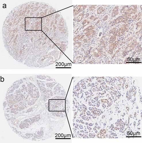 Figure 6. Photomicrographs of immunohistochemical staining for PPP1CB in PAAD clinical patient tissue samples. (a) Positive staining for PPP1CB. (b) Negative staining for PPP1CB. PPP1CB: protein phosphatase 1 catalytic subunit beta