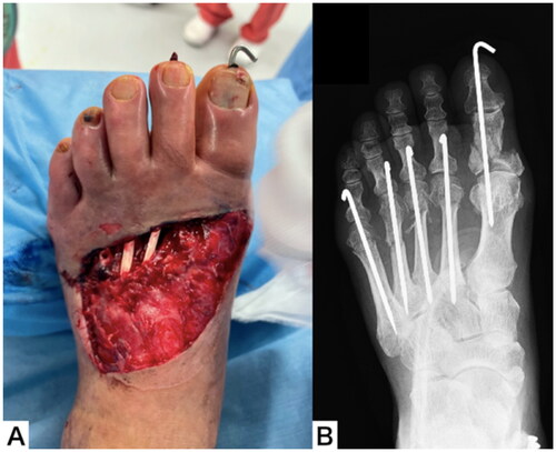 Figure 2. Appearance (A) and plain radiograph (B) of the left foot after Emergency operation.