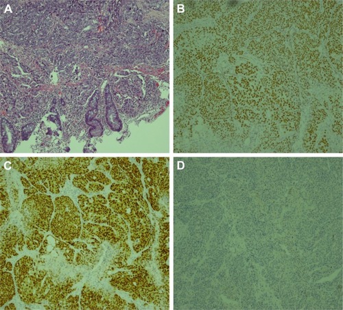 Figure 6 Microscopic observation and immunochemistry of rectal neoplasm.