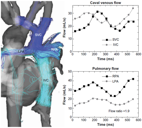 Figure 6 Quantification and visualization of caval venous and pulmonary hemodynamics.