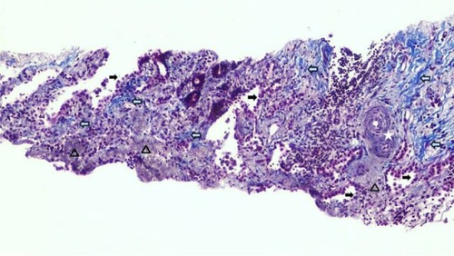 Figure 5 Lung biopsy showing increased interstitial collagen (⇦ blue), elastic fibers (a gray), activated pneumocytes (➞), and pathological vessels with thickened walls. ☆ 100×.