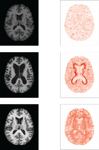 Figure 14. MRI image (left) and DO heatmap (right) of subjects 387 (top), 92 (middle), and 126 (bottom).