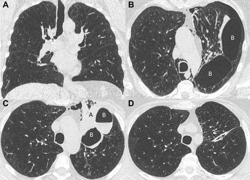 Figure 5 Chest CT evolution (patient 5). (A) Baseline chest CT before endobronchial valves insertion in the left upper lobe (LUL). (B) Chest CT performed one day after valves insertion. We can see the hypoventilation of the LUL, presence of a pneumothorax (P) which did not require chest tube drainage, pneumomediastinum and the occurrence of two new bullae (B) between the upper and lower lobes. (C) Chest CT performed 5 days after valves insertion. There is a regression of the pneumomediastinum, increasing of the atelectasis (A) and the bullae (B) with an air–liquid level. (D) Chest CT performed 63 days after valves insertion with a partial atelectasis of the LUL and a nearly complete resolution of both bullae (B).