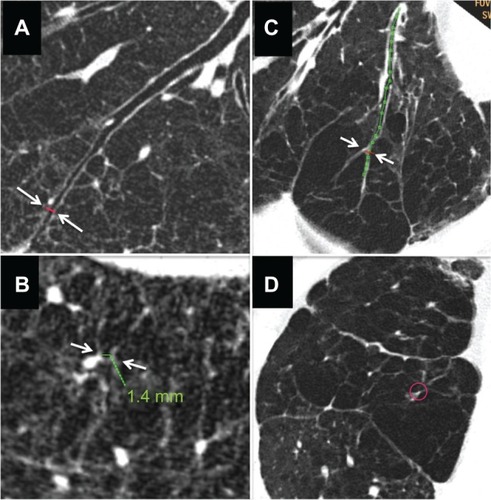 Figure 4 Computed tomography images of severe emphysema and airway lumen-obliterated emphysema. (A) Reconstructed image of longitudinal airway view of severe emphysema with little parenchyma around septum or vessels (arrows indicate the point where image B was reconstructed within 2 cm from pleura). (B) Reconstructed image of view exactly perpendicular image to airway axis at red line in panel A (arrows indicate the airway used for image reconstruction). Even in peripheral airway within 2 cm from the pleura airway lumens could be observed. Green line indicates the size of the airway. (C) Reconstructed image of longitudinal airway view of airway lumen-obliterated emphysema. The airway lumen is obliterated at the proximal levels of the bronchi (>2 cm apart from the surface of the lung), and subsegmental areas lacking parenchyma were observed. The obliterated bronchus could be traced into the air-trapped emphysematous area (arrows indicate the point where image D was reconstructed). (D) Reconstructed image of view exactly perpendicular to the long axis of the bronchus at the red line in panel C. Red circle indicates the airway which was used for image reconstruction.