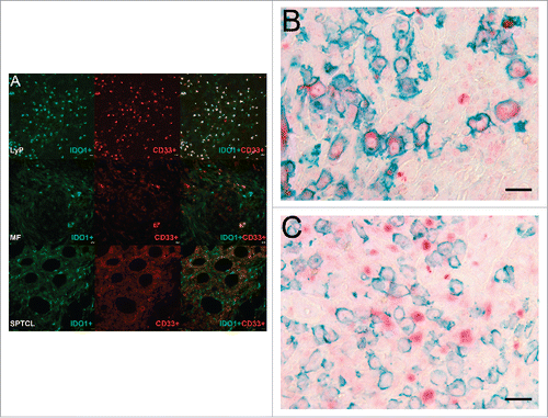 Figure 5. CD33+/IDO1+ expressing MDSCs are found in CTCL. (A) Double immunofluorescence staining of CD33 (red) and IDO1 (green) in typical LyP, MF, and SPTCL specimens. The top panel row shows a LyP tissue section with many strong double positive IDO1+/CD33+ cells (yellow) and some single positive IDO1+ or CD33+ cells. The second panel row shows an MF tissue section with cells either positive for IDO1+ or CD33+ as well as a few double positive IDO1+/CD33+ cells at lower right. The third panel row from top shows a SPTCL with double positive IDO1+/CD33+ cells as well as single positive cells (40x). In addition, IDO1 is expressed by both (B) CD30-positive and (C) CD30-negative cells in LyP (40x magnification). (Scale bar 20 µm).