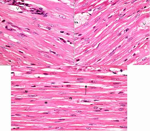 Figure 2. A photomicrograph of treated rat left ventricle of arsenic intoxicated group (group II) showing, widely separated cardiomyocytes by wide spaces (↑), dilated blood vessels (v) some contain vacuolated material (Va), hyalinosis and loss of striation (*). (H&E stain, X 100).