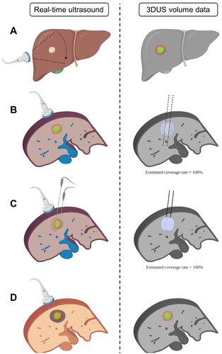 Figure 1. 3DUS FI technique in precise needle placement for HCC thermal ablation. (A) 3DUS volume data around the tumor was acquired by freehand scanning (left). Tumor (green) was automatically segmented and a 5 mm ablative margin (red) was displayed (right). (B) The plan of needle placement was made through predetermined simulative ablation zone (light blue), and the estimated coverage rate was automatically calculated. (C) Ablation needles were placed according to the plan with 3DUS fusion imaging guidance. The planned puncture path and depth was shown in red dashed line, and the planned ablation zone was shown in red circle in real-time 2DUS. (D) Intraoperative assessment of the coverage of ablation zone was conducted through CEUS and 3DUS fusion imaging.