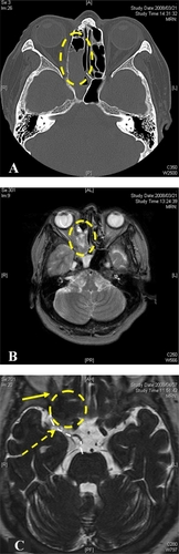 Figure 1 Tumor mass occupying the frontal sinuses and part of the right anterior ethmoidal sinus. Before steroid pulse therapy, the mass occupies much of the ethmoidal sinus on computed tomography (CT) (A) and magnetic resonance imaging (MRI) (B) T2-weighed MRI showed isointense mass. (C) Despite steroid pulse therapy and endoscopic sinus surgery, the tumor expanded to compress the optic nerve (yellow arrow) and oculomotor nerve. Contrast-enhanced MRI showed low intensity mass in T2 image. (Broken circle indicates the tumor, broken white line indicates the oculomotor nerve and broken yellow arrow indicates the compression point).