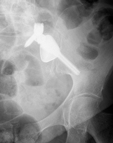 Figure 10 Postoperative radiologic result a.p. after implantation of the implant.