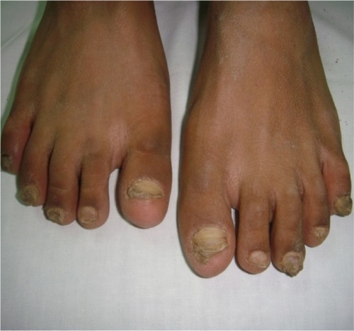 Figure 1 Subungual hyperkeratosis with nail dystrophy in patient with KID syndrome.