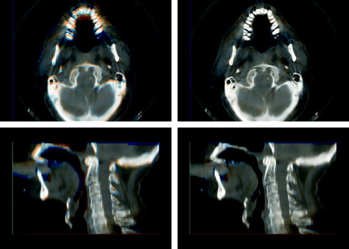 Figure 4.  Red/blue visualization of the difference between the rigid registration (left) and the deformable registration (right) of CBCT image 3 to CBCT image 1. A saggital slice and an axial slice are shown for each registration.
