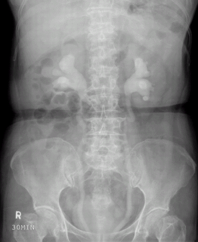 Figure 1. IVP showed bilateral moderate hydronephrosis with hydroureter.