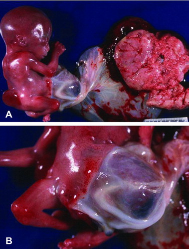 Figure 2.  (A) Gross picture of Patient 1 showing fetus with attached cord and placenta. (B) Closer view of short umbilical cord covered with amnion. Notice a large interface of abdominal skin with omphalocele sac.