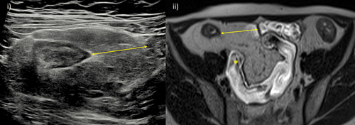 Figure 4. Mesenteric fat wrapping. A 29-year-old female Crohn’s disease patient with signs of extensive fat wrapping of the terminal ileum. i) IUS with mesenteric fat wrapping involving most of the small bowel circumference and displacing a loop of ileum (arrow). ii) Comparable axial T2-weighted MRE image, also showing resultant separation of the terminal ileum from other loops of pelvic ileum (arrow). MRE also demonstrates terminal ileal stricturing disease with reduced luminal caliber and mild pre-stenotic dilation (asterisk).