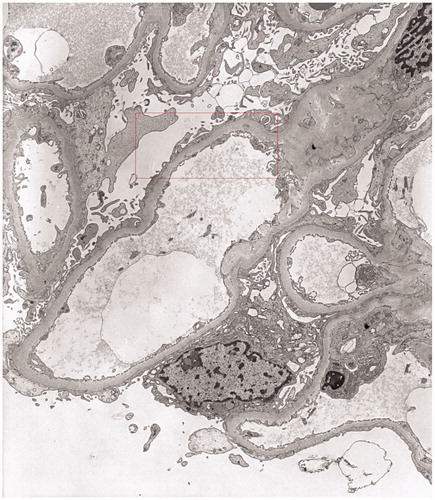 Figure 3. Electron microscopy: widespread foot process fusion in the absence of electron-dense deposits, UrPb (5000×).