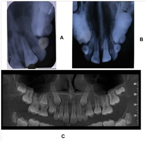 Figure 2 (A) Periapical radiography of 21 region does not show any significant bone lesion. (B) Maxillary occlusal radiography does not reveal any significant bone changes. (C) Orthopantomography does not show any bone lesion either.