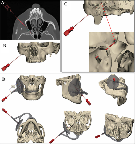 Figure 2 Digitization of maxillofacial bones and puncture path. (A) Patients’ preoperative CT image and the puncture route from the right maxillofacial region to the foramen rotundum; (B and C) The 3D models of head bones and the puncture route from the right maxillofacial region to the foramen rotundum; (D) The skull model with the digital tooth-supported template and the puncture path viewed from a different angle.