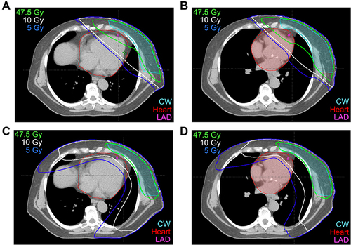 Figure 2 Axial sections with isodose lines for a patient planned for left chestwall and regional nodal treatment (including the internal mammary chain lymph nodes) using four different techniques. (A) Free breathing (FB) 3DCRT, (B) DIBH 3DCRT, (C) FB VMAT, (D) DIBH VMAT.