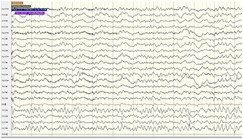 Figure 4. EEG when the patient woke up in alert and oriented state in Day #14.