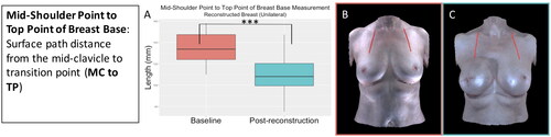 Figure 5. The mid-shoulder point to top point of breast base measurement (mid-clavicle to transition point) significantly decreased in the reconstructed breast after unilateral implant-based reconstruction (p < 0.001). (A) Boxplot of the mid-shoulder point to top point of breast base measurement at baseline and post-reconstruction (median and interquartile range). (B) The mid-shoulder point to top point of breast base measurement on an exemplar patient at baseline. (C) The mid-shoulder point to top point of breast base measurement on the same patient post-reconstruction.