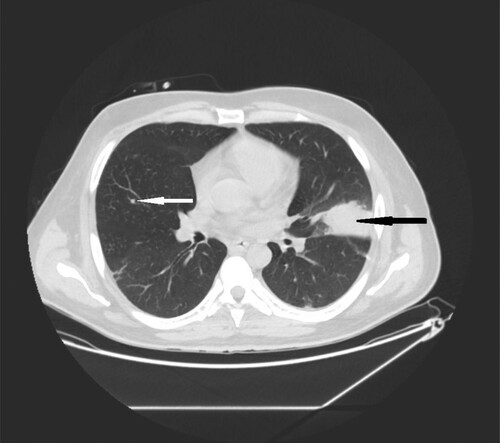 Figure 2. 35-year-old male with acute myeloid leukemia presenting with dry cough. High resolution CT obtained at level of pulmonary veins shows wedge-shape consolidations located in lingular segment in left lung (black narrow arrow). Nodule in the middle lobe of the right lung (white narrow arrow).