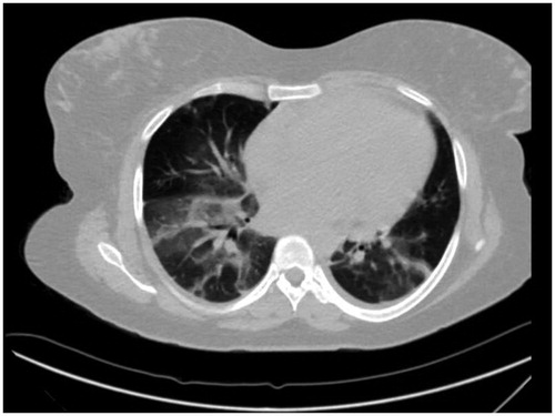 Figure 1. Chest CT without contrast Day 3: bilateral lower lung airspace disease. Additionally, there are peripheral linear/wedge-shaped opacities within the right upper and lower, as well as the left lower lobes.