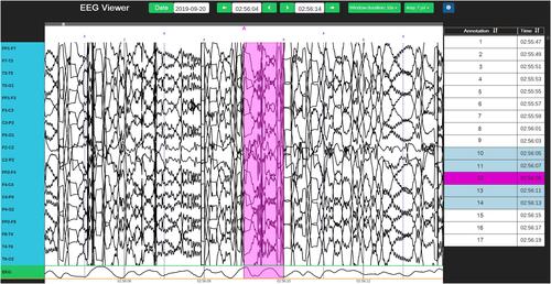 Figure 4 Visualization of abnormal EEG signals found by the intelligent component.
