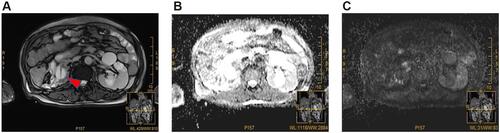 Figure 1 MRI of postoperative right renal percutaneous nephrostomy. (A) The axial T2-weighted MR images showing right renal atrophy, empyema in the right upper ureter with increased thickness and signal intensity in the perinephric fat and Gerota’s fascia; there is a water balloon of nephrostomy tube (red head of arrow). (B and C) MRI showed no abnormal diffusion restriction in the right kidney.