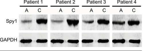 Figure 2 The representative Spy1 expression levels in colorectal cancer (CRC) tissues were detected by western blot assay and compared with adjacent tissues.Note: The Spy1 levels in CRC tissue were significantly overexpressed compared to those in the adjacent tissues, and GAPDH was used as a loading control.Abbreviations: A, adjacent tissues; C, cancer tissues.