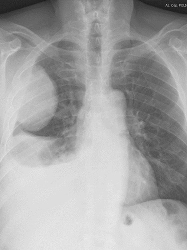 Figure 3 Sarcomatoid carcinoma of the right lung presenting as a large, rounded mass at chest X-rays.