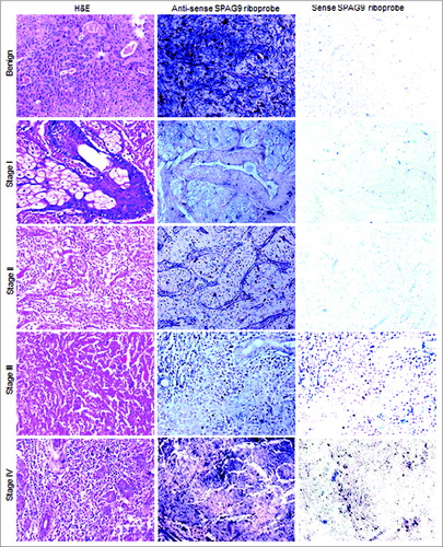 Figure 2. Analysis of SPAG9 gene expression in SGT patients by in situ RNA hybridization. Representative images of H&E staining for benign, malignant stage I, II, III, and IV tumors are shown in left panel. The serial tissue sections probed with anti-sense riboprobes resulted in violet blue color as shown in the middle panel, whereas no hybridization was observed when probed with sense riboprobes as shown in the right panel. Original magnification: x200; objective: x20.