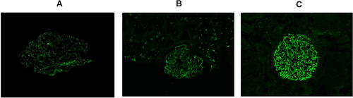 Figure 1 (A) Kidney tissue PLA2R immunofluorescence positive 1+. (B) Kidney tissue PLA2R immunofluorescence positive 2+. (C) Kidney tissue PLA2R immunofluorescence positive 3+.