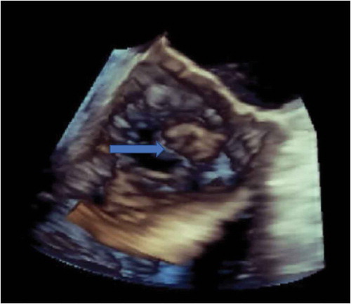 Figure 3. 3-D Echocardiogram showing vegetation (blue arrow) on the non-coronary cusp of aortic valve.