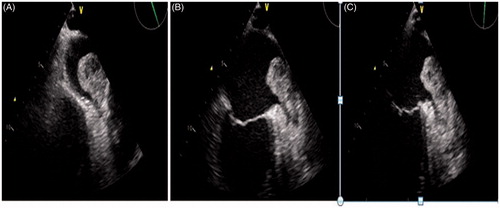 Figure 1. Transeosophageal echocardiography (TEE) showing a huge trombus in LA/LAA (A), TEE image is being shown after five-day treatment of acetylsalicylic acid, unfractionated heparin and tirofiban (B), there was no change in trombus size and shape on10th day of the same treatment.