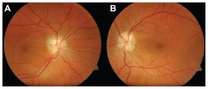 Figure 1 A, B) Fundus photograph shows with a bilateral peripapillary and a macular detachment extending from the right optic disc to the macula. B) In left eye, two anular images correspond to pigment epithelium detachments within inferior temporal vein.