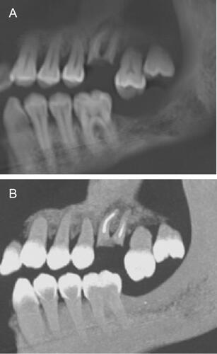 Figure 10. (A) Left side, first maxillary molar in the form of roots with endodontic treatment-egression second molar. (B) Maximum intensity projection mode in idem.