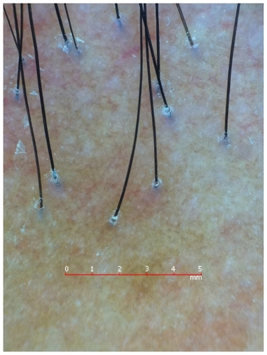 Figure 3 Lichen planopilaris: loss of follicular openings and perifollicular casts.