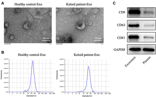 Figure 1 Exosomes are successfully collected from peripheral blood of healthy controls and patients with keloid. (A and B) Exosomes (healthy control-Exo and keloid patient-Exo) were isolated from peripheral blood of healthy controls (n = 3) and patients with keloid (n = 3). The isolated exosomes were identified using TEM and NTA analysis. (C) Western blot assay was used to detect CD9, CD63 and CD81 protein expressions in isolated exosomes and plasma of peripheral blood plasma (n = 3).