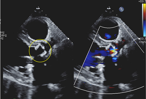 Figure 3 Moderate central AI and moderate stenosis 2 years after CABG and AVR using a 19-mm SRDV (yellow).