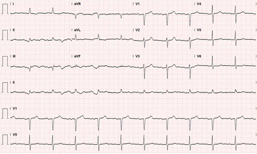 Figure 3. EKG showing prolonged PR interval or first degree AV block.