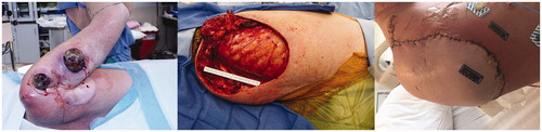 Figure 1. Case I pre-operative mass, intra-operative defect and post-operative healed flap .