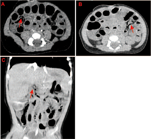 Figure 1 Computed tomography (CT) scan of abdomen showing pneumatosis intestinalis (A and B) and portal venous gas (C) (indicated by the red arrows).