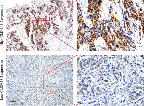 Figure 1 Representative images from immunohistochemical staining of CLDN 18.2 expression in human GC tissues. Scale bars, 100 μm.