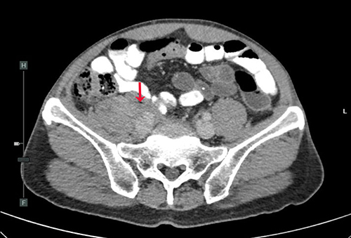 Figure 6 Computed tomography (CT) scan of chest and whole abdomen demonstrating infiltrative soft-tissue mass surrounding the periaortic and aortocaval regions with extension to involve the right psoas muscle (red arrow).