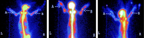Figure 1. Radionuclide bone imaging photo of experimental group.
