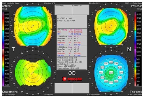 Figure 3 Preoperative tomographic corneal map of a 32-year old male patient (DEE) in group 2.