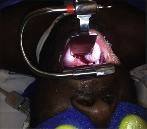 Figure 6 The MOR system in place demonstrating the access available to the supraglottic and glottic regions of the throat for surgery.